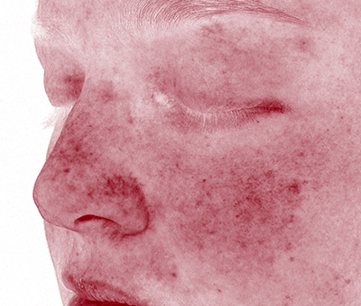 See Real Before and After Skin Treatment Results