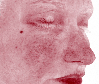 See Real Before and After Skin Treatment Results